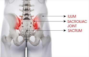 Sacroiliac Joint Dysfunction