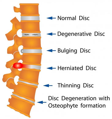 disc herniation