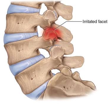 facet joint dysfunction Back Pain