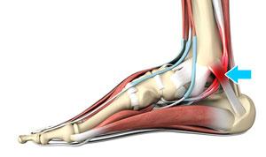 foot tarsal tunnel syndrome